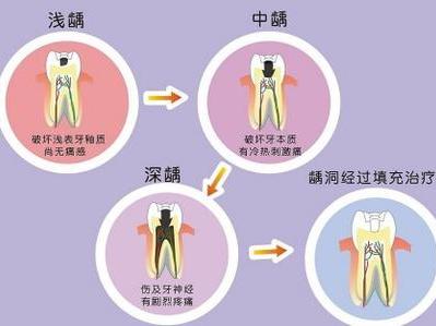 如何知道自己有沒有蟲牙？