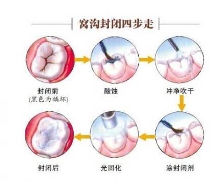 孩子少吃糖能預(yù)防齲齒嗎？