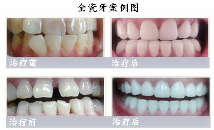 烤瓷牙矯正牙齒的優(yōu)勢(shì)有哪些？