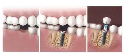 單顆牙缺失怎么修復(fù)比較好？