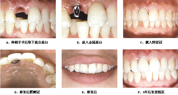 種植牙的主要步驟有哪些？