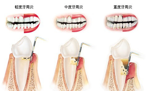 牙周炎治療后會(huì)復(fù)發(fā)嗎？