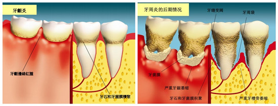 牙齦炎治療后會(huì)復(fù)發(fā)嗎？