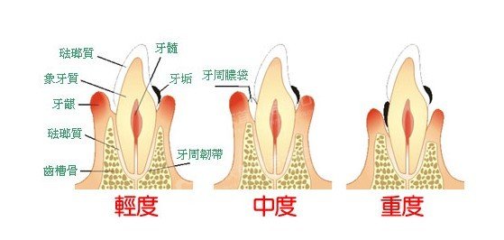 深圳治療牙周炎要多少錢？