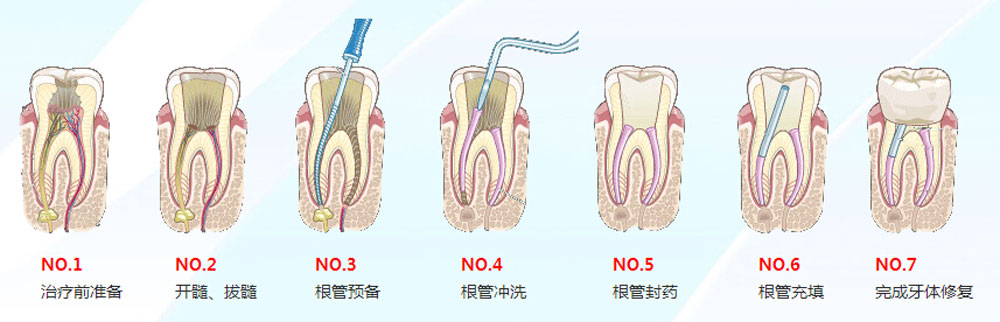 深圳做根管治療一般多少錢？