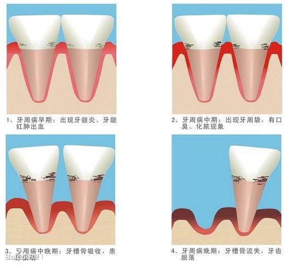 得了牙周病怎么辦？