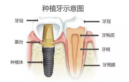 種植牙選什么種植系統(tǒng)比較好？