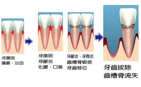 牙周病都有哪些危害？