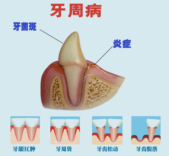 牙周病對(duì)人體有哪些危害？