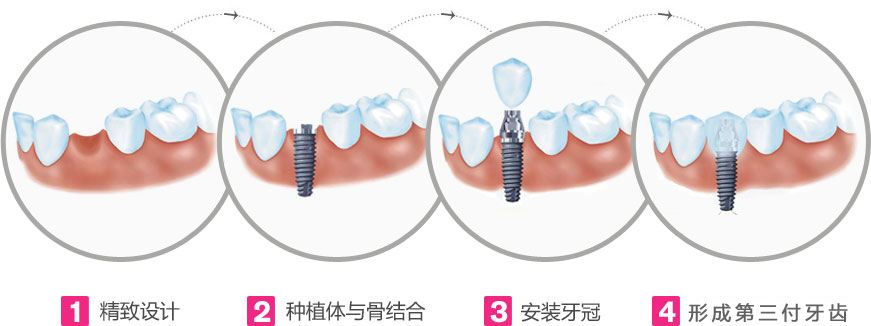 種植牙價(jià)格差別大應(yīng)該怎么選？