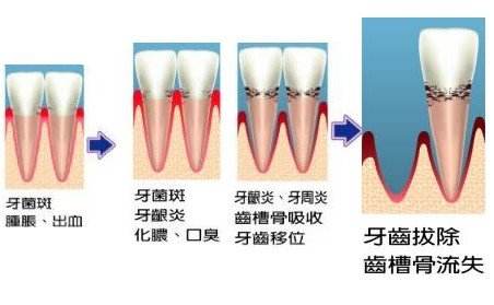 孕期常見的牙周問題有哪些？