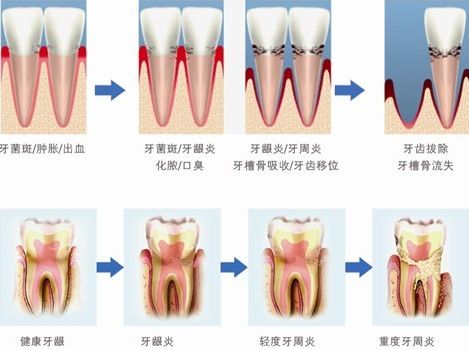 孕期牙周病怎么治療比較好？