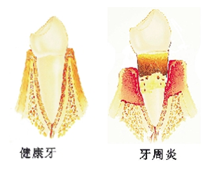 牙周炎犯了怎么辦？