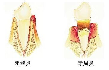 牙齦炎和牙周炎的區(qū)別有哪些？