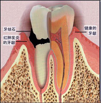牙齦炎的外在癥狀有哪些？