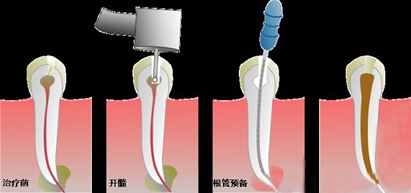 根管治療期間要注意哪些事項？