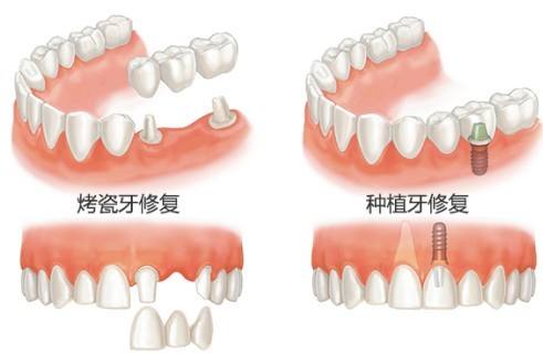 種植牙相比烤瓷牙有哪些優(yōu)勢(shì)？