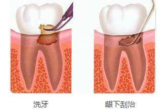 洗牙和牙周刮治有什么區(qū)別？