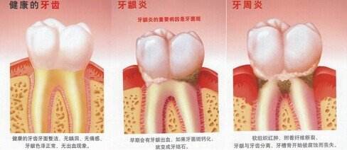 深圳得了牙齦炎怎么治？