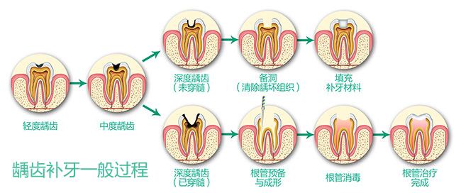 深圳補牙多少錢？