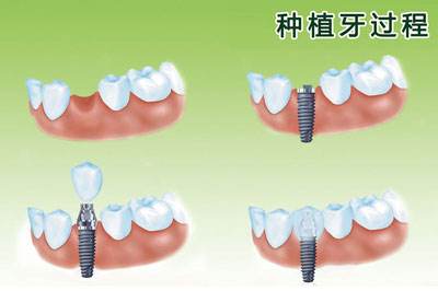 深圳種植牙要多長時(shí)間？