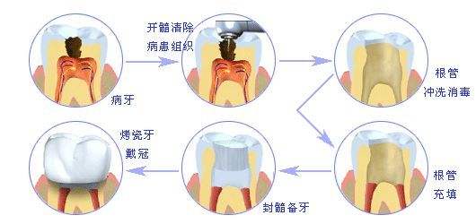 深圳治療牙髓炎要多少錢(qián)？