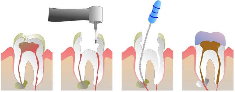 深圳治療牙髓炎方法有哪些？