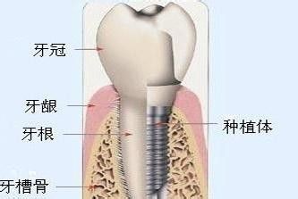 深圳種植牙危害有哪些？