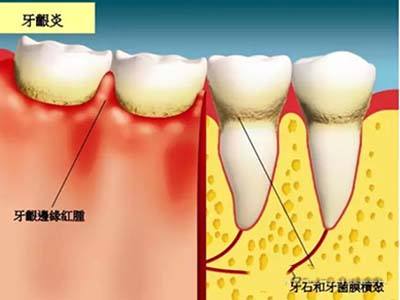 深圳孕婦牙齦炎怎么辦？