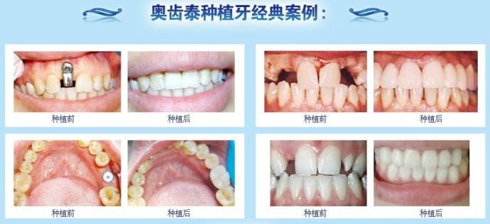 深圳奧齒泰種植牙價(jià)格是多少？