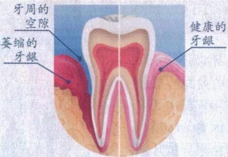 牙齦萎縮可以恢復(fù)嗎？