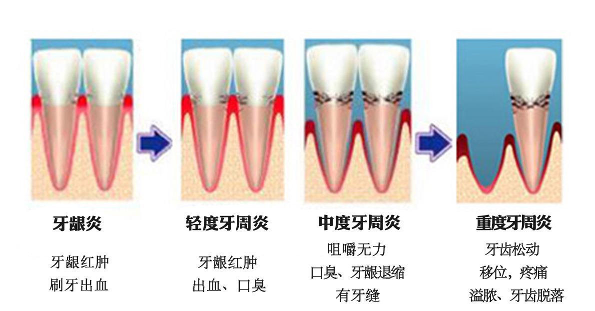 深圳牙周炎的治療方法