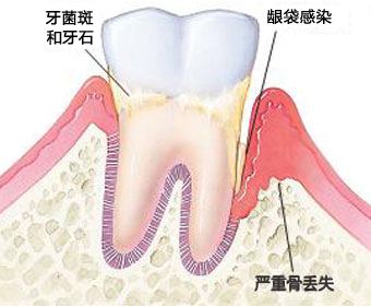 深圳牙菌斑該怎么去除？