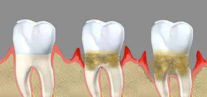 深圳牙齦萎縮怎么辦？