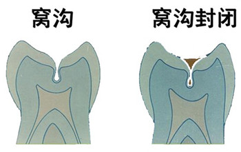 深圳窩溝封閉有必要嗎？