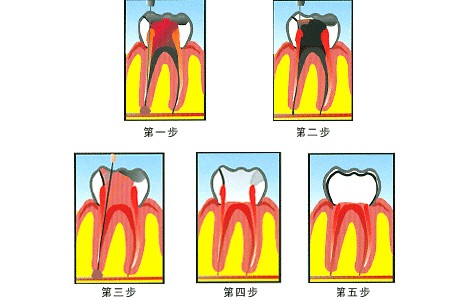 深圳牙齒做根管治療需要多少錢？