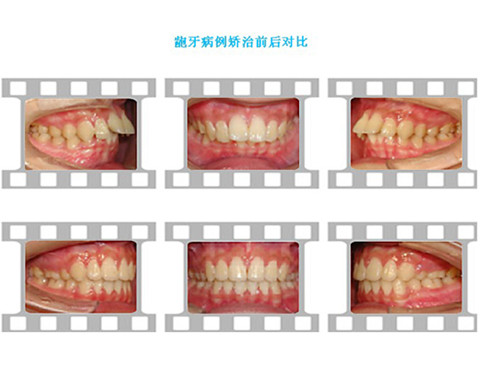 深圳矯正齙牙要多長時(shí)間？