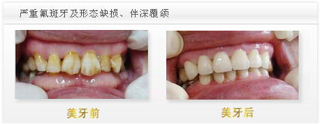 深圳氟斑牙治療方法