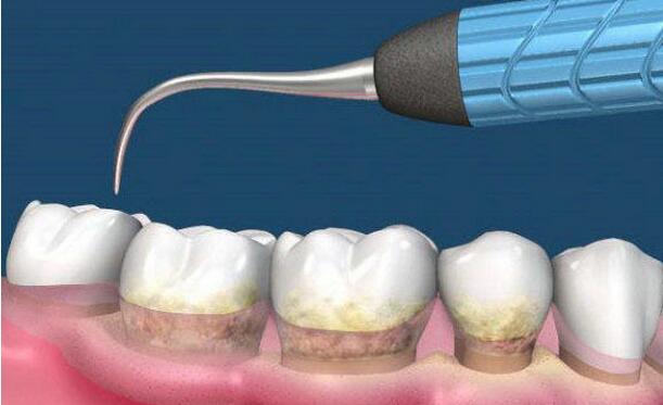 深圳怎樣才能去除牙結(jié)石？
