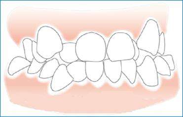 深圳牙齒擁擠危害有哪些？