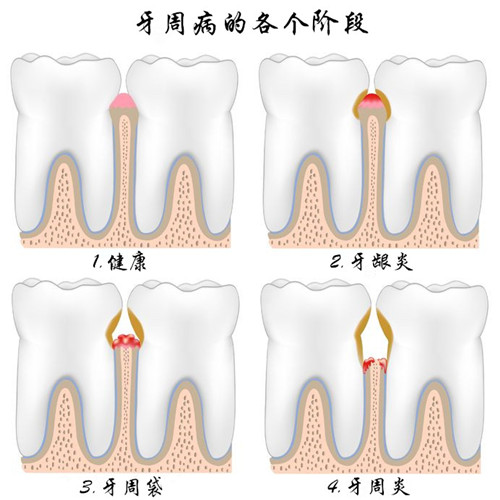 深圳孕婦牙周炎怎么辦？