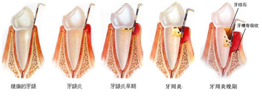 深圳牙周炎癥狀有哪些？