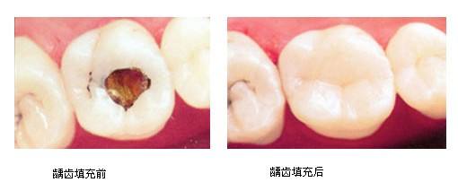 深圳齲齒牙洞填充要多少錢？