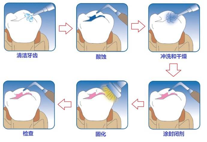 深圳怎么做窩溝封閉？