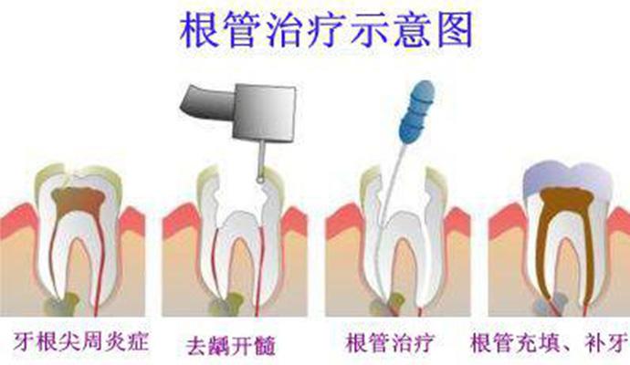 深圳牙齒根管治療價格