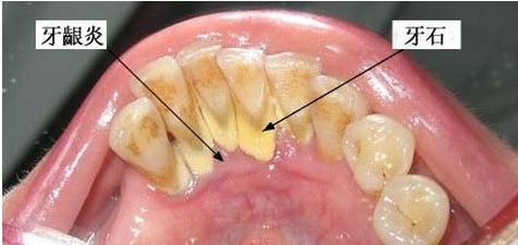 深圳為什么會(huì)形成牙結(jié)石？