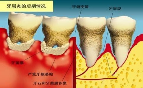 牙周炎需要拔牙嗎？