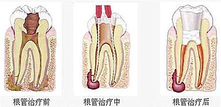 兒童牙齒根管治療需要多少錢？