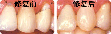 牙齒表面楔狀缺損應(yīng)該怎么辦？