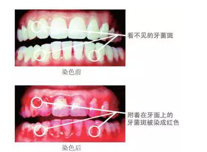 孩子牙齒上有牙菌斑怎么治療？